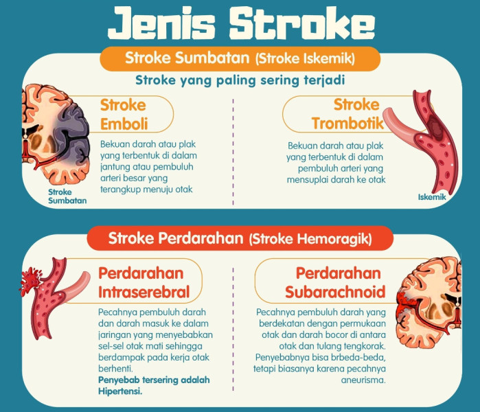 Dinkes Inhil: Yuk Kita Mengenal Lebih Dekat Tentang Penyakit Stroke Jenis dan Kondisinya