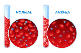 Dinkes Inhil : Anemia Jadi Masalah Kesehatan Serius