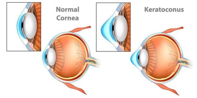 Dinas Kesehatan Inhil Ajak Masyarakat Waspadai Penyakit Keratoconus